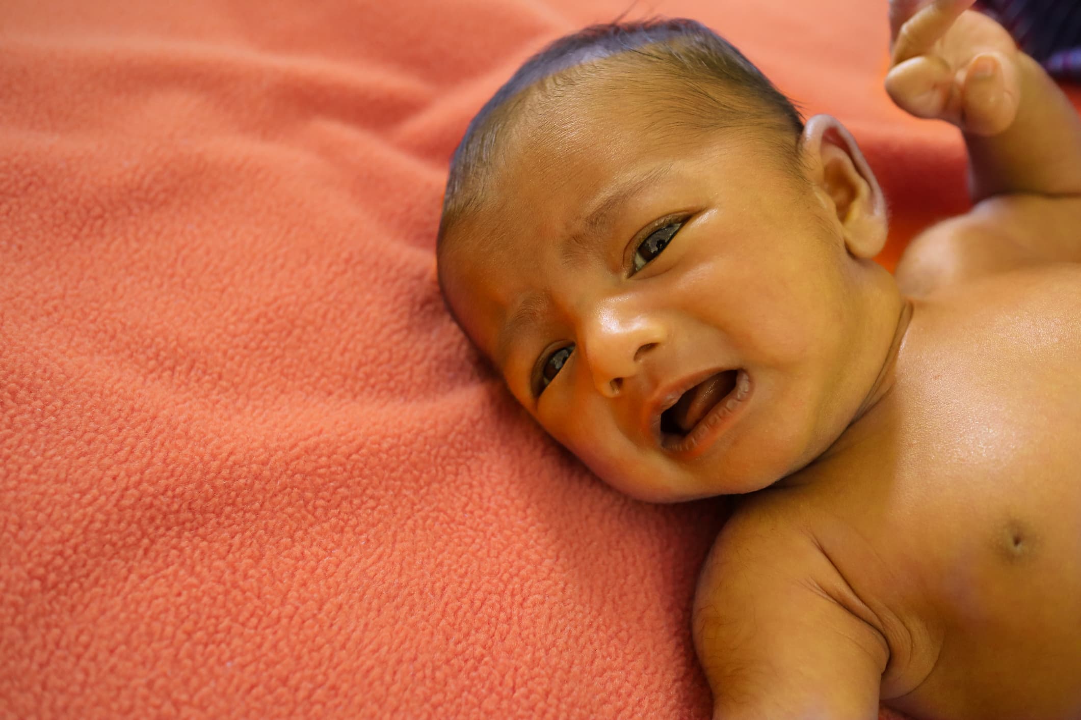 Understanding the Symptoms of Jaundice in Newborn Babies