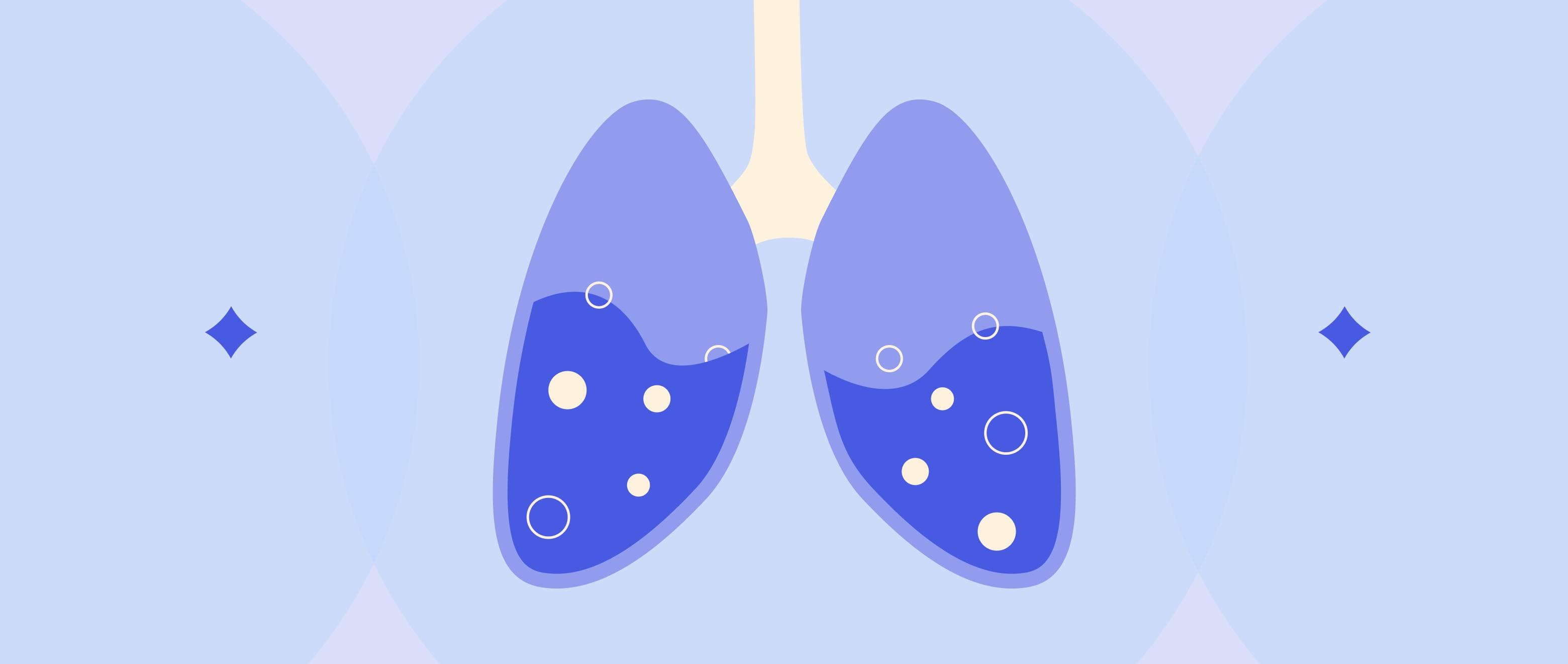 Pulmonary Oedema: When It Feels Like a Flood in Your Lungs