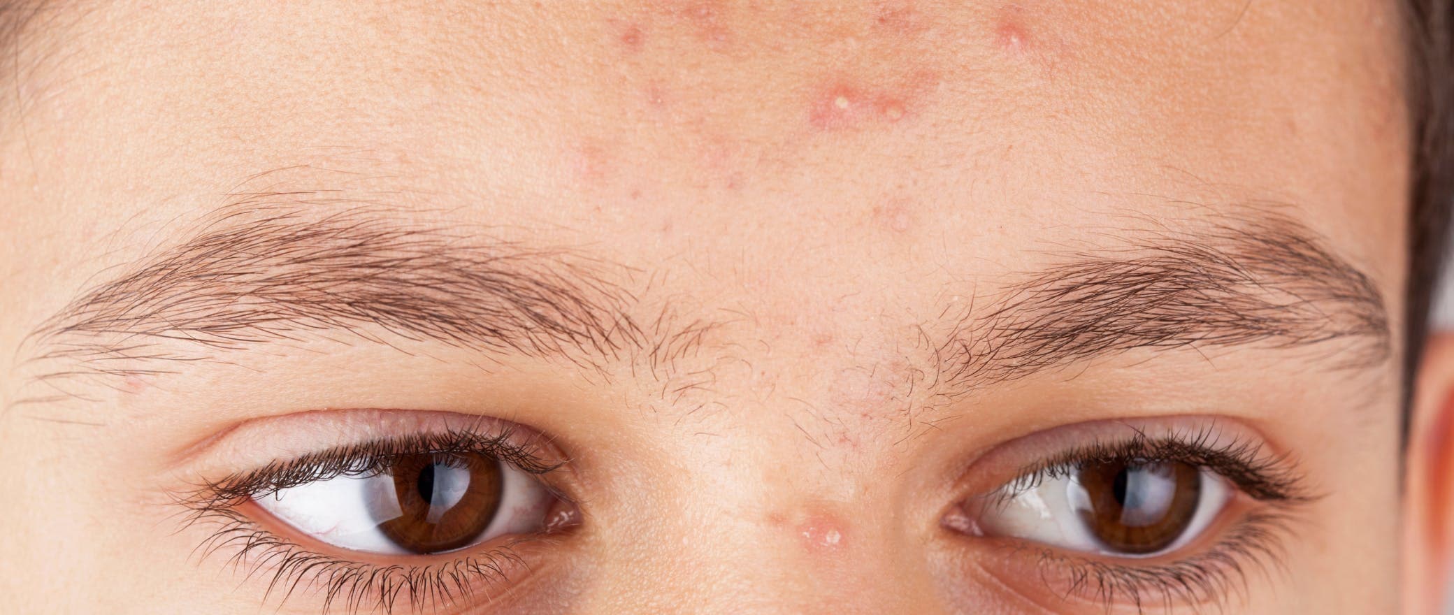 All You Need to Know About Acne 