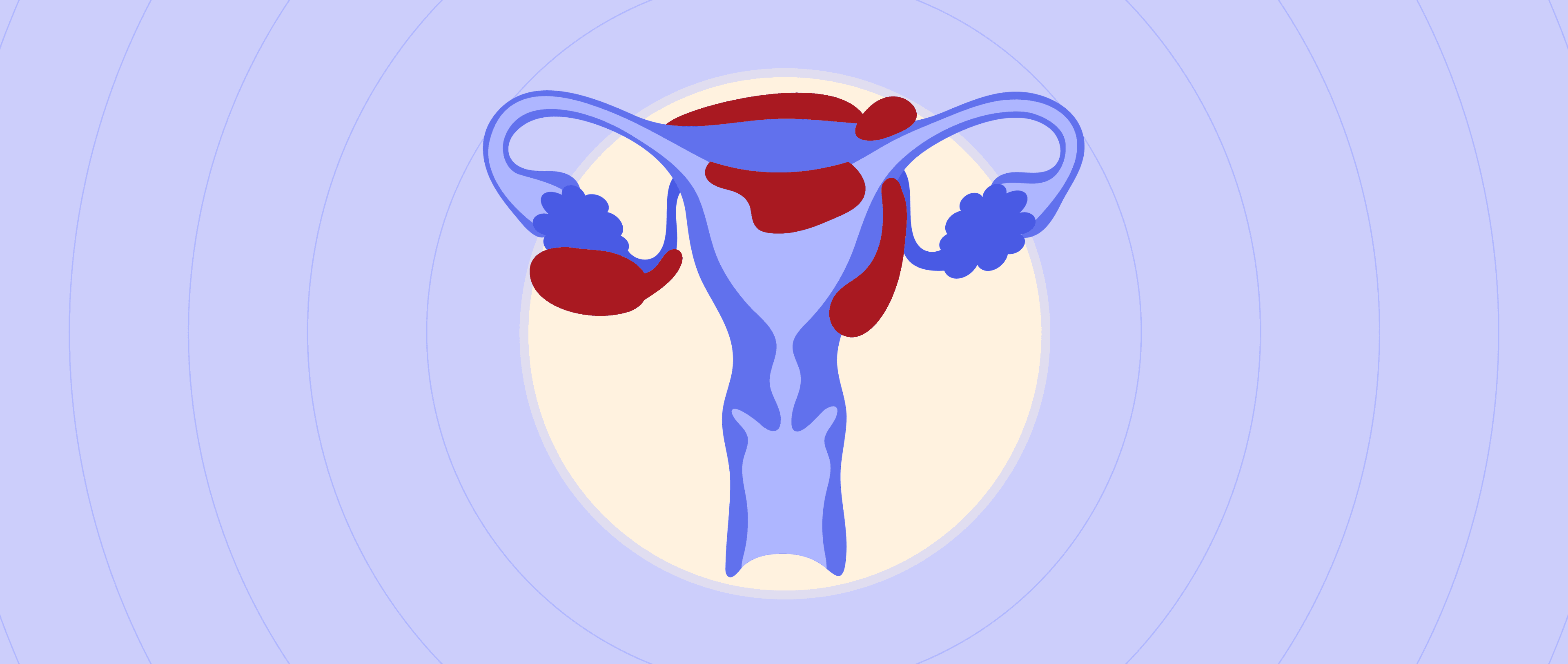 Beyond the Bellyache: Understanding Endometriosis