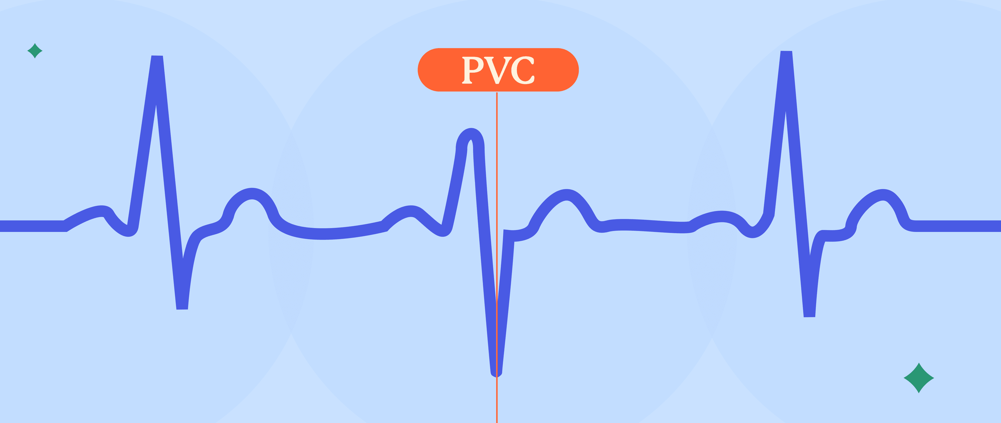 Premature Ventricular Contractions: Is Your Heart Freestyling?