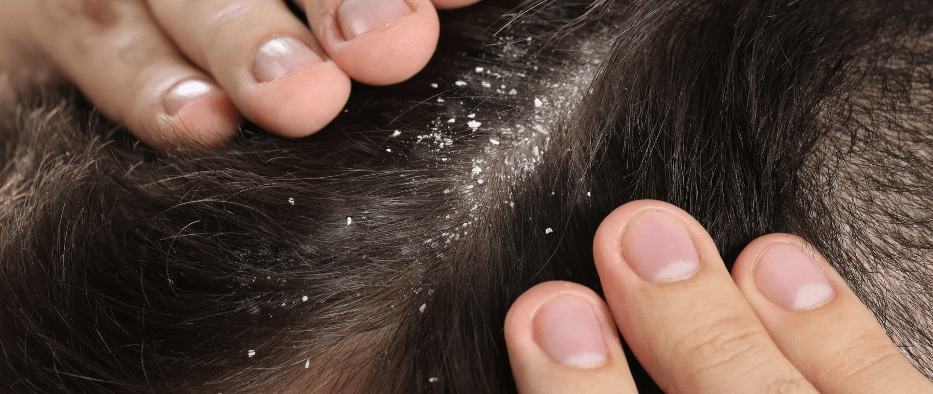 Bye-bye, Snowflakes! How to Get Rid of Dandruff for Good