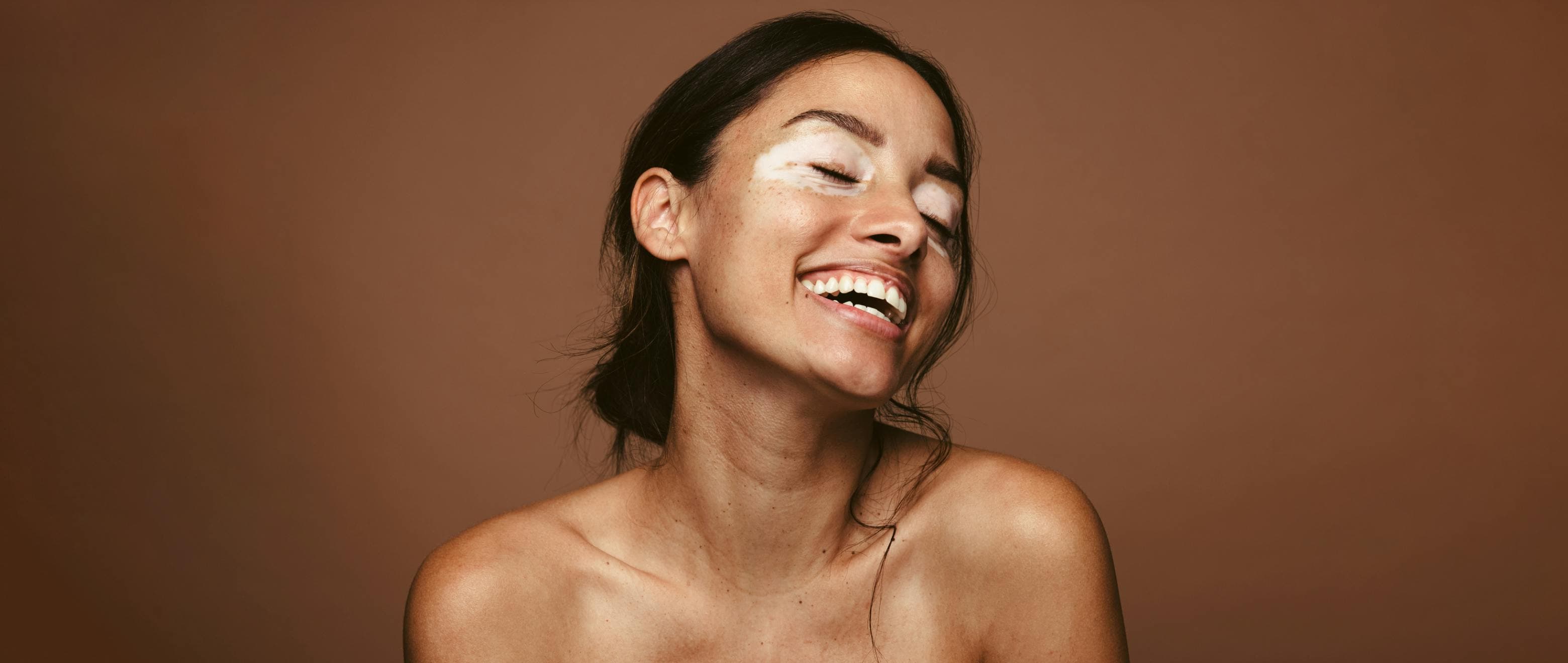 Vitiligo: When Your Skin Pigment Decides to Go Incognito