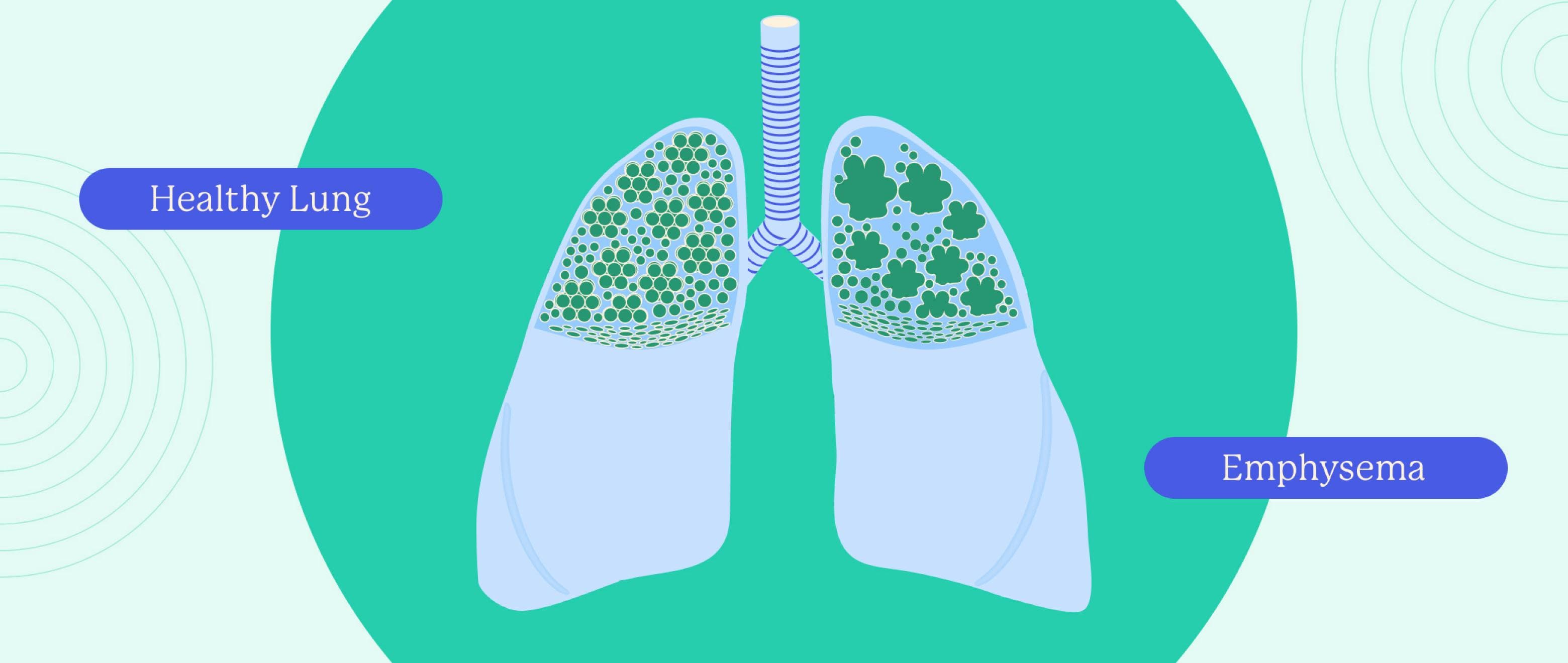 Always Out of Breath? It Might Be Emphysema