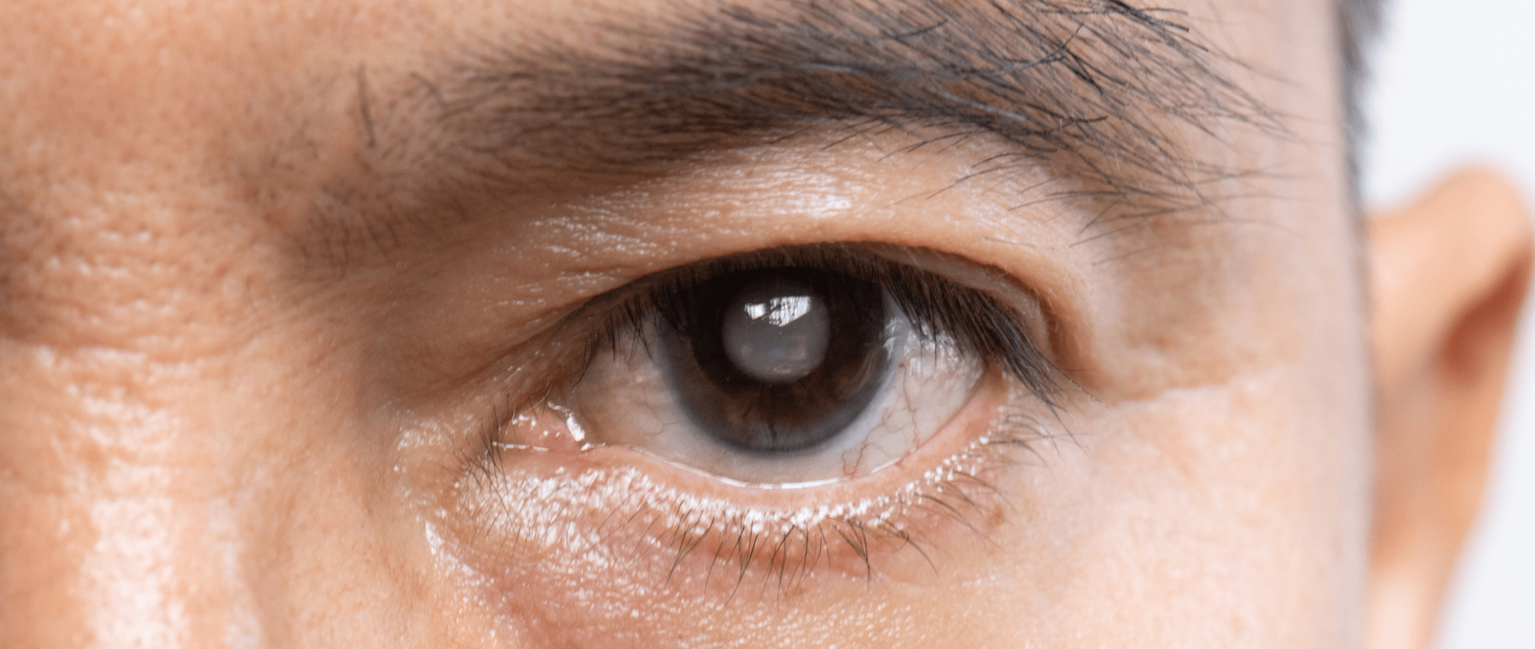 Protect Your Eyes: Don’t Let Glaucoma Cloud Your View