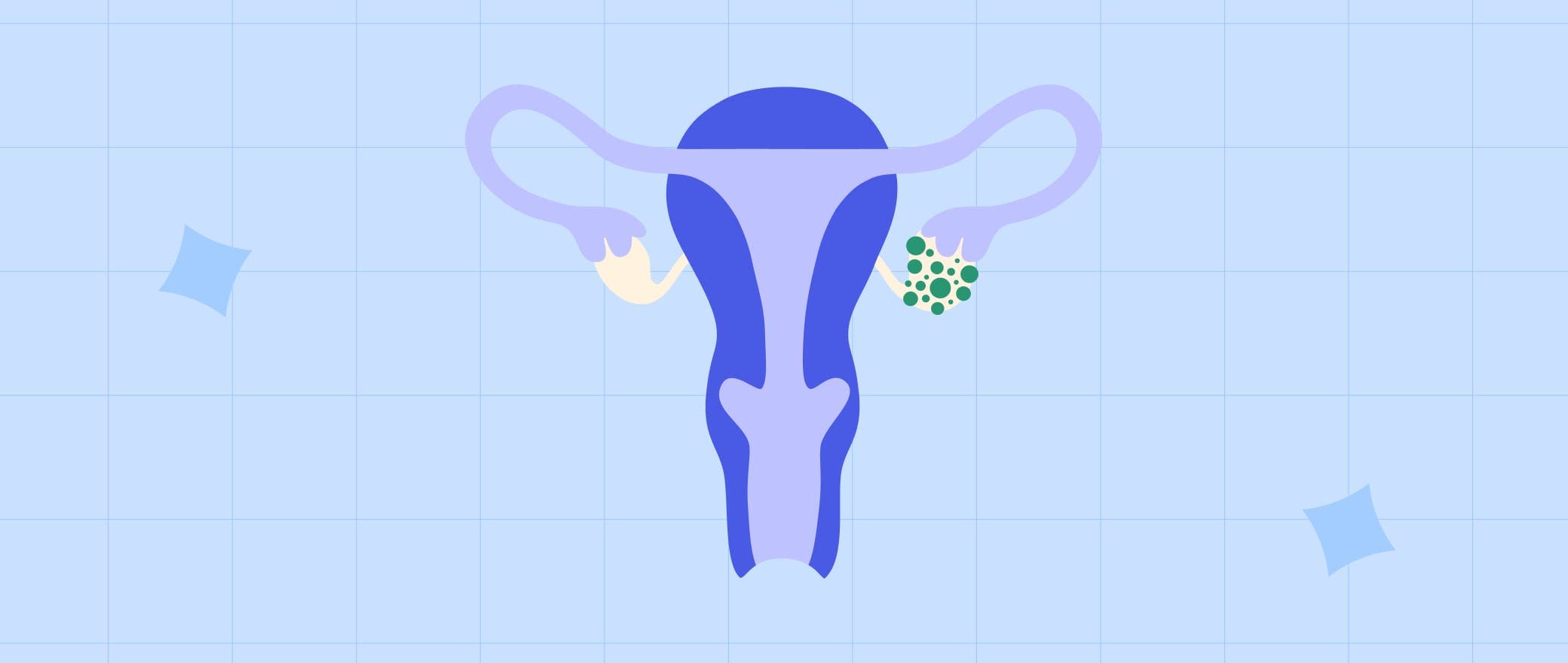 Pelvic Pain Doubling You Down? It’s Time to Learn About Ovarian Cysts