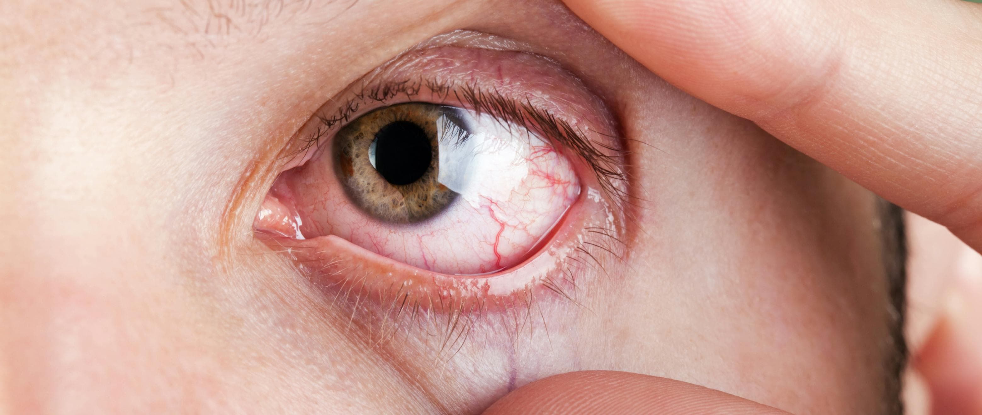 When the Sahara Hits Your Eye Sockets: Learn Why You Have Dry Eyes