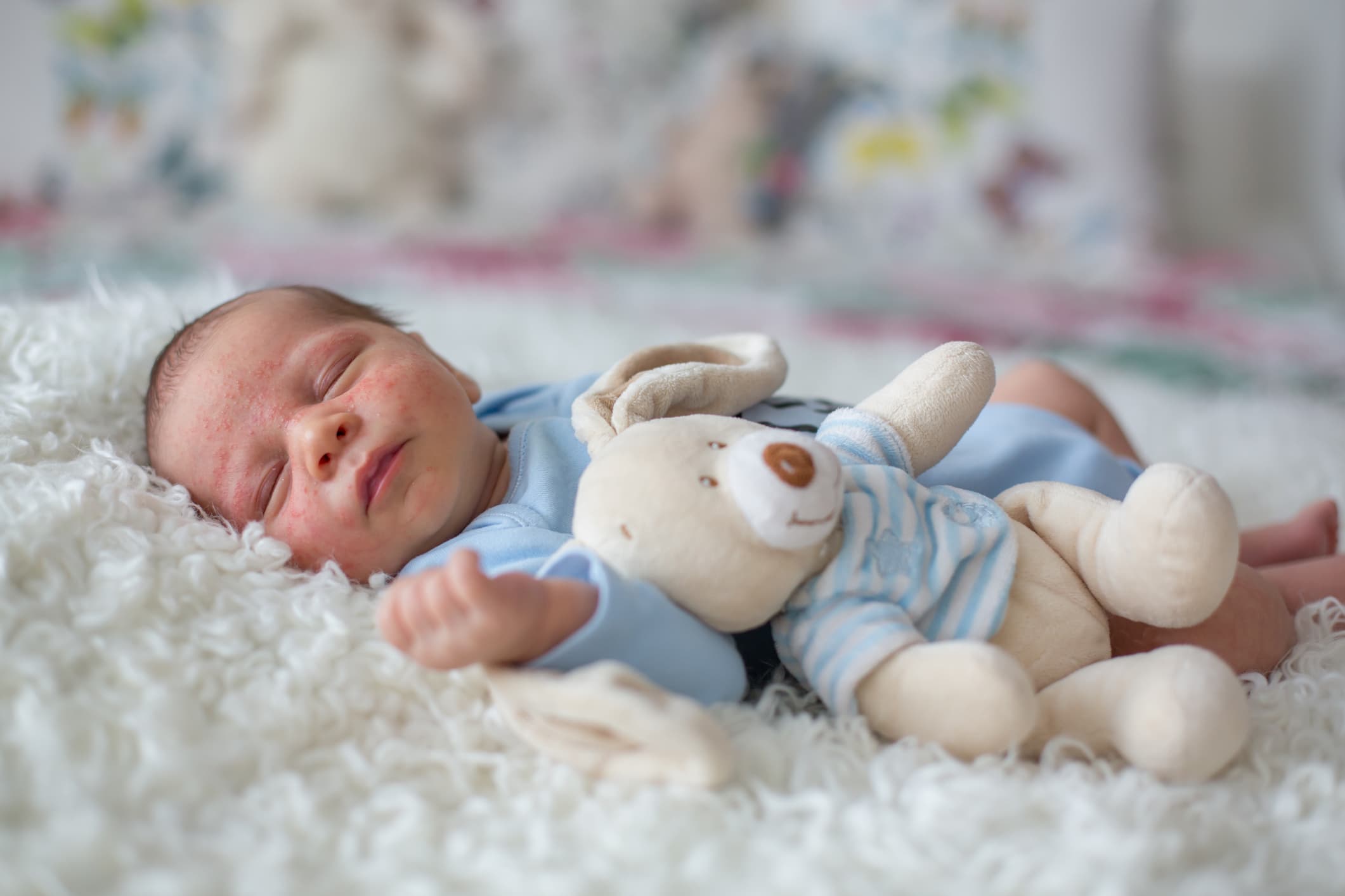 Baby Acne: Everything Parents Need to Know